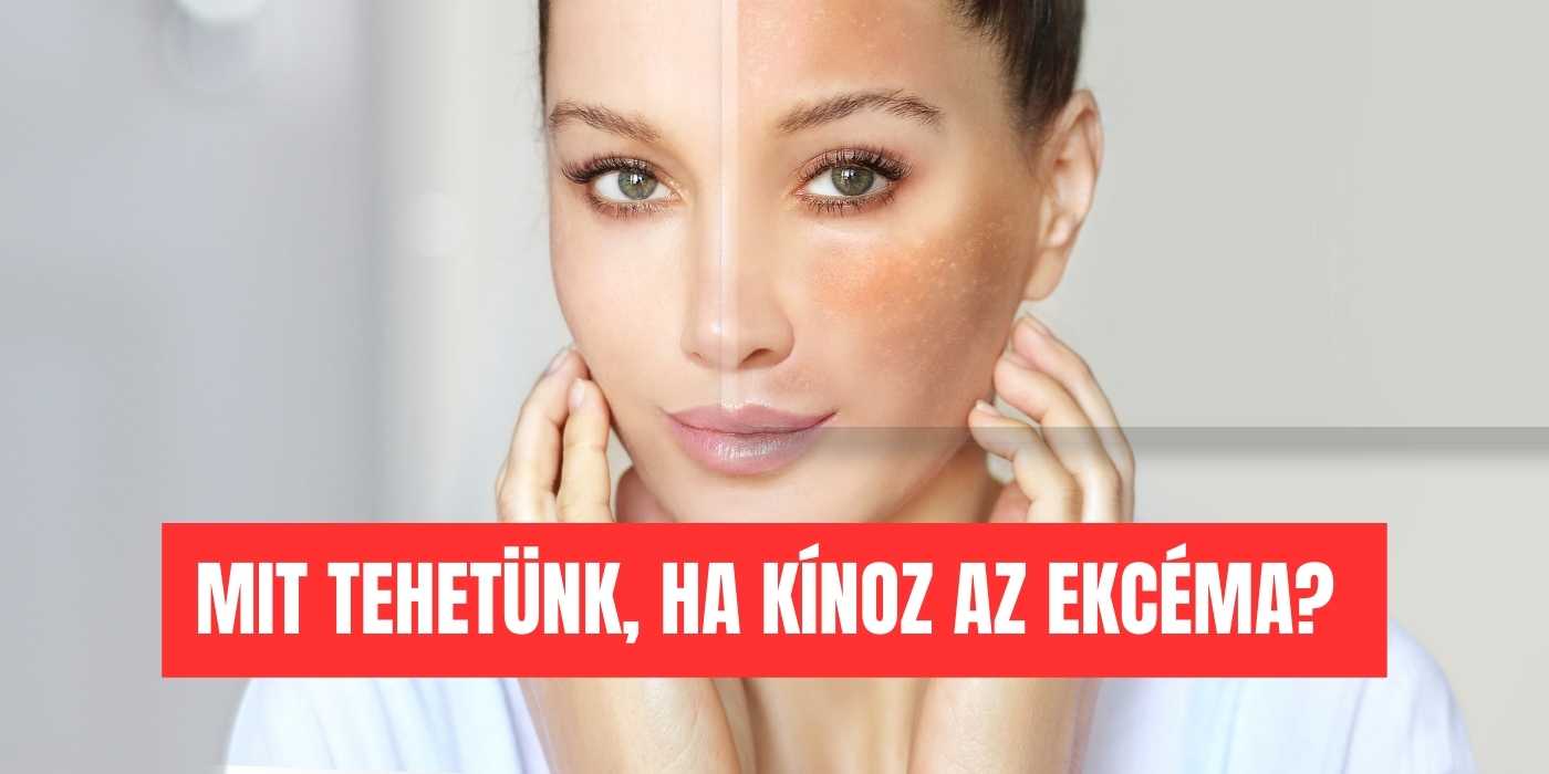 ekcémás bőr viszket, piros, száraz